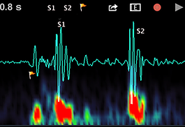 iphone heart recording iphone heart recording